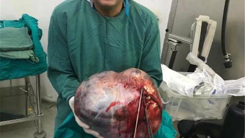 استئصال ورم يزن 37 كجم من بطن سبعينية