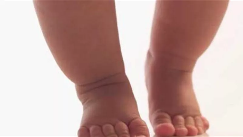 3 نصائح تحمى طفلك من الاصابة بالكساح