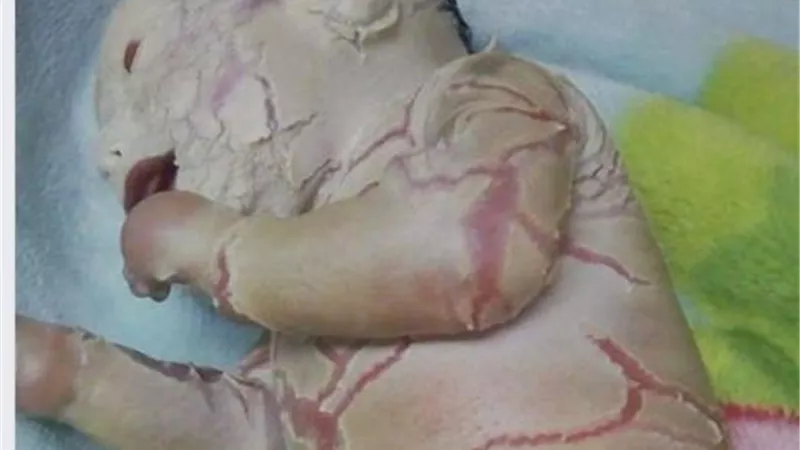 القصة من البداية للنهاية.. مرض نادر يحول 