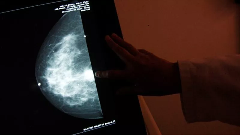 تقنية جديدة لعلاج سرطان الثدي في أسبوع