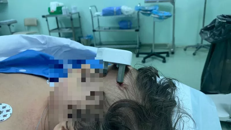 اخترق الجمجمة .. سقوط طفل على رأس شاحن الهاتف.. صورة