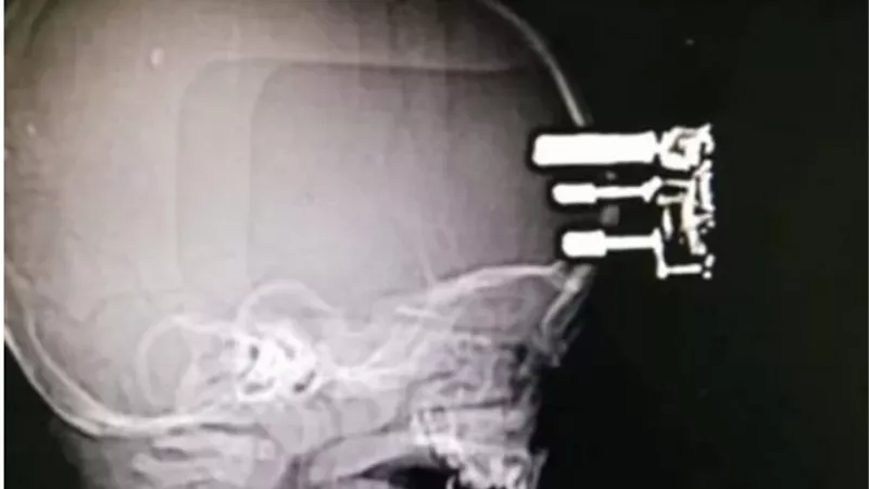 إخراج شاحن موبايل من جمجمة طفل في السعودية.. صور