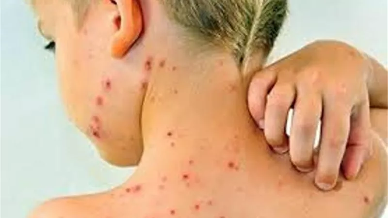 إنهاء حالة الطوارىء المفروضة فى ساموا بسبب تفشى الحصبة