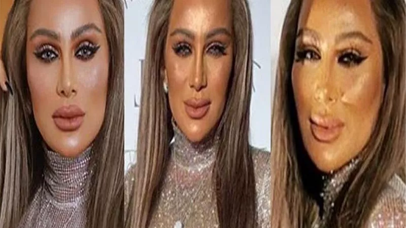 عملية تجميل 