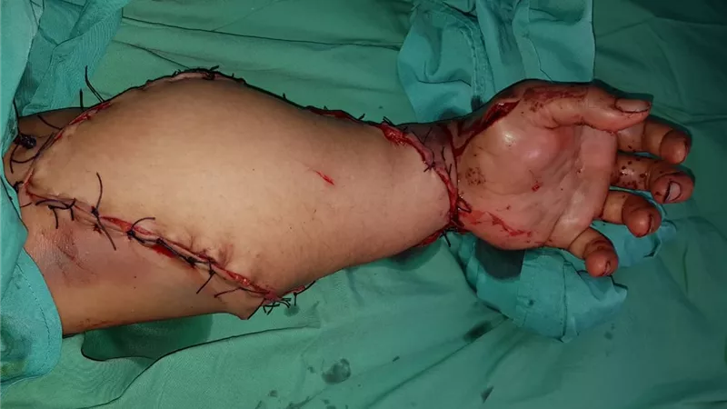انقاذ ذراع سيدة من البتر بمستشفى قنا الجامعى