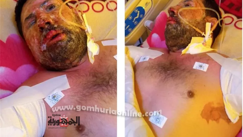 عبد الرحمن يطالب بحقه .. التيار العالي أفقده ذراعيه.. وصاحب المصنع: ماحدث خارج العمل.. صور