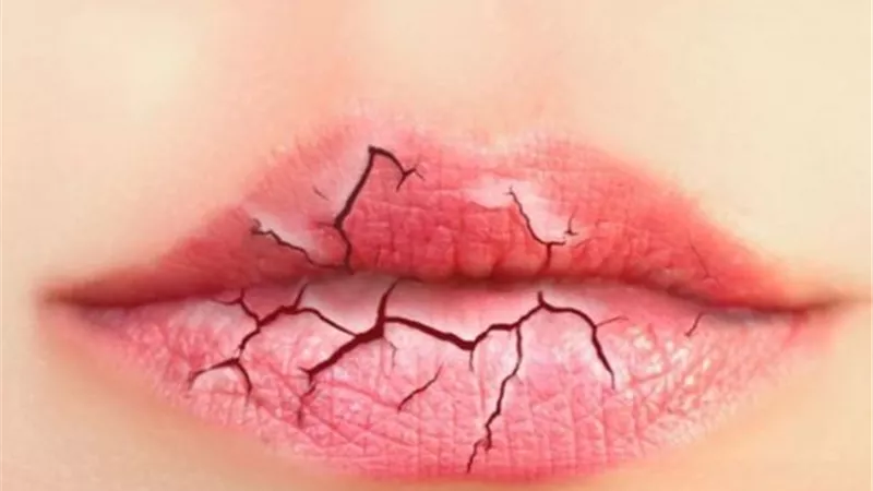5 طرق لعلاج تشقق الشفاه
