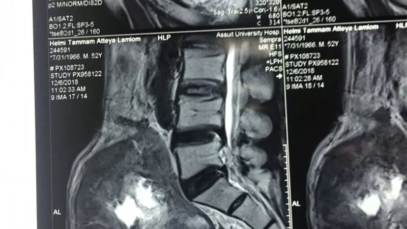 نجاح فريق طبي بأسيوط في استئصال ورم متضخم بالمثانة البولية