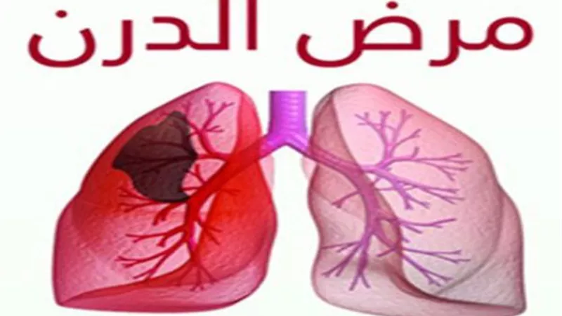 الحكومة تكشف حقيقة ارتفاع معدل الإصابة بمرض الدرن في مصر