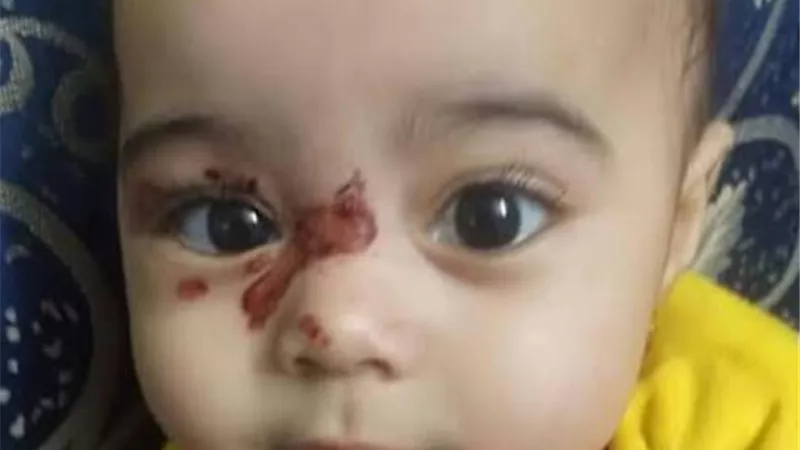 حروق باليد والوجه .. القصة الكاملة لتعذيب طفلة على يد والدتها