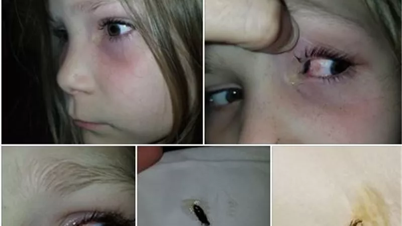 خنفساء تستقر فى عين طفلة 9 ساعات حتى استخراجها