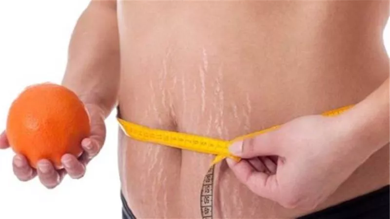 أطعمة تتسبب فى إصابتك بالسيلوليت ..أبرزها السكريات