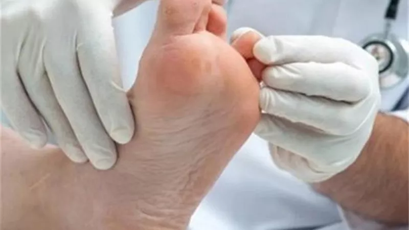 عين السمكة.. الوقاية وطرق العلاج