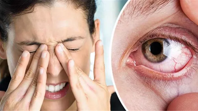 أسباب جفاف العين وأعراضه