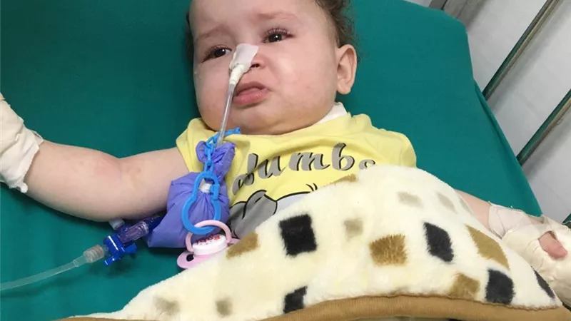 فريق طبي يتمكن من زراعة قولون لطفلة عمرها 7 شهور ولدت بدون مريء