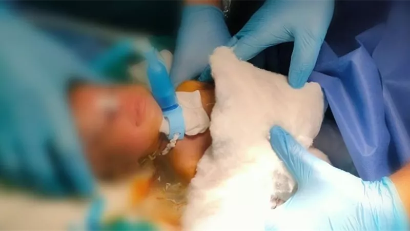 لأول مرة اجراء عملية جراحة شق حنجرى لطفل عمره 54 يوما بالسويس