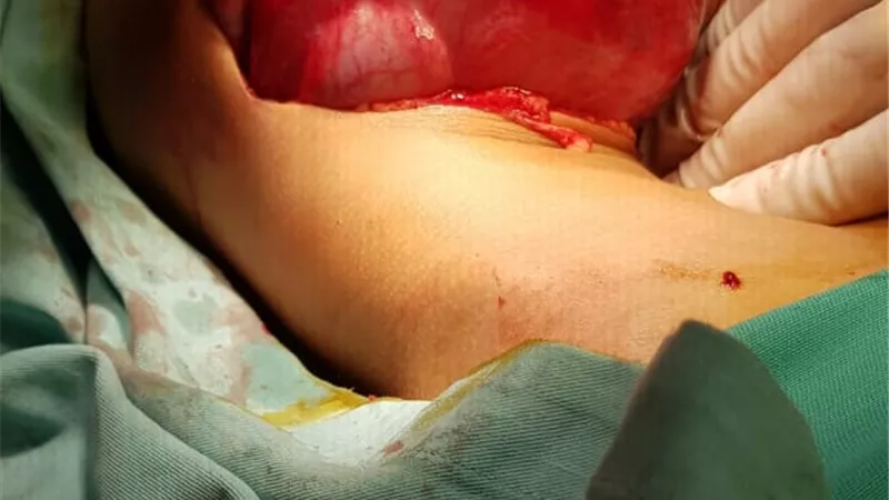 انقاذ حياة طفل عمره عامين بعد استئصال ورم من كبده