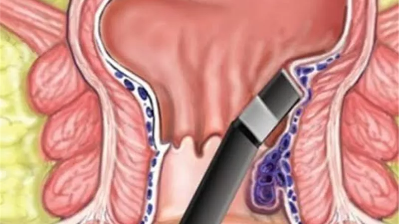 أسباب الإصابة بالبواسير
