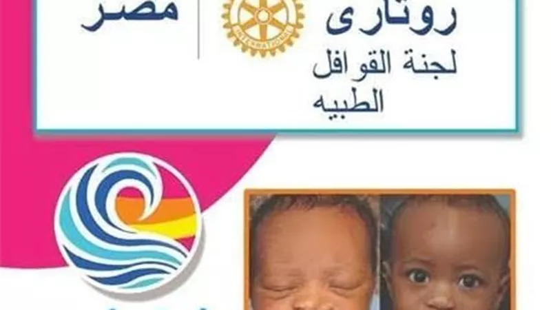 روتاري مصر يستقدم فريق طبي أمريكي لعلاج الشفة الأرنبية 13 مارس