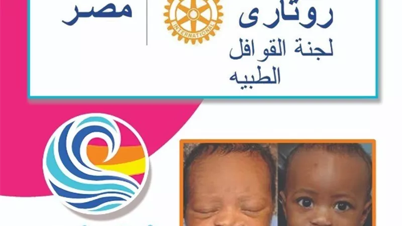 22 فبراير.. انطلاق قافلة روتارى لعلاج الشفة الأرنبية وسقف الحلق الدولية بالأقصر