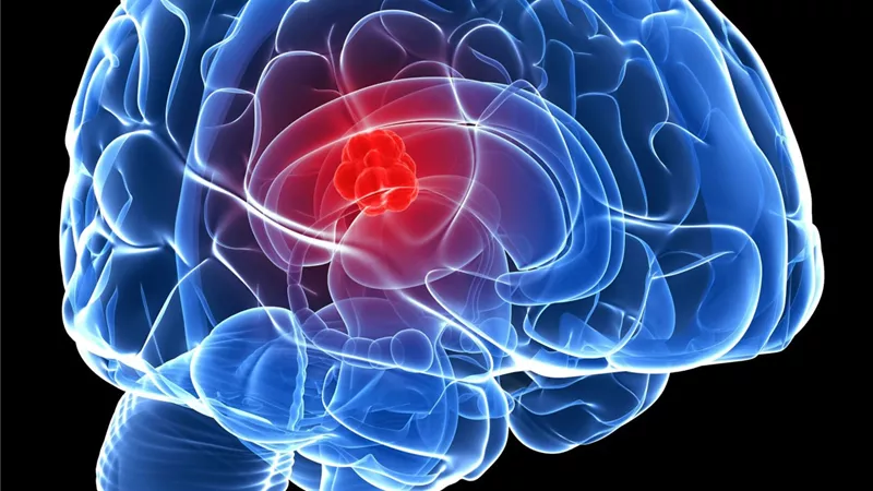 انطلاق مؤتمر الجمعيه المصريه لطب الاعصاب لمناقشة كيفية التعامل مع مريض الجلطة