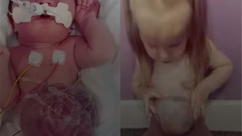 بالصور.. حالة نادرة لطفلة تعيش بأعضاء خارج بطنها