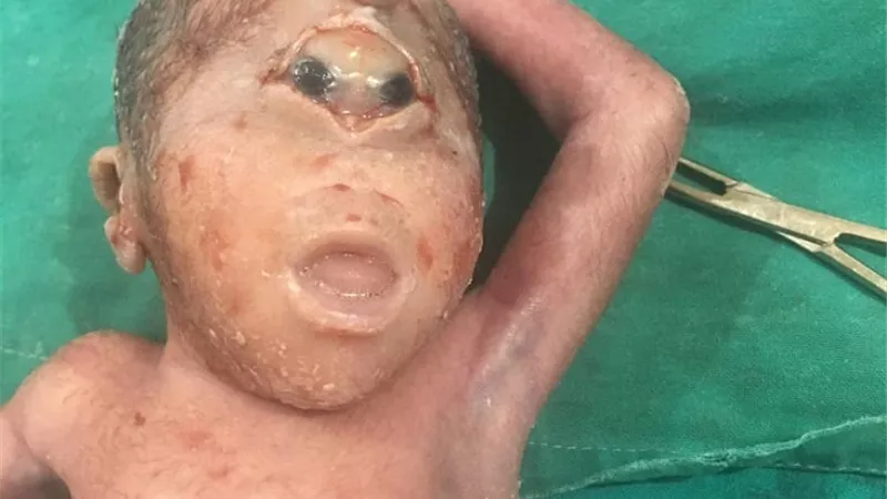 ولادة طفل بعين واحدة ووفاته بعد 45 دقيقة بأرمنت جنوب الأقصر