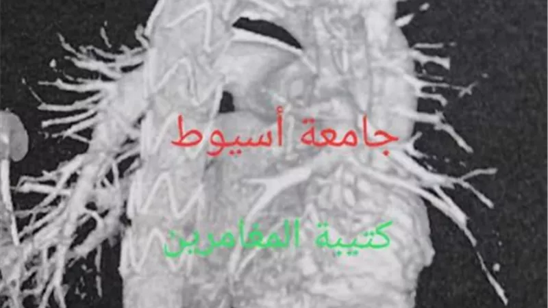 جامعة اسيوط تعلن عن نجاح فريق طبى بقسم الأوعية الدموية
