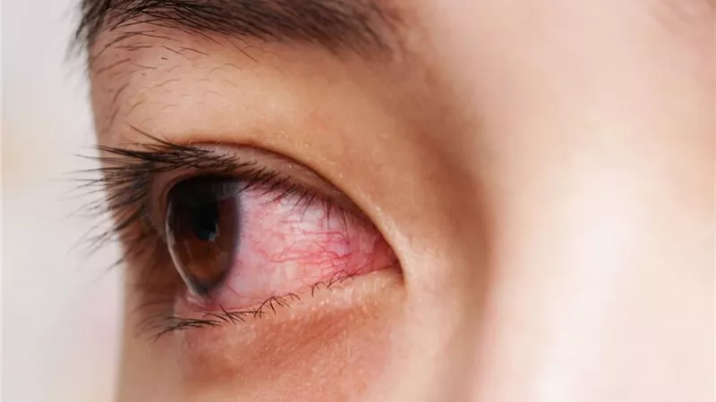 تفعلها يوميًا.. 5 عادات خاطئة تصيبك بالتهاب القرنية