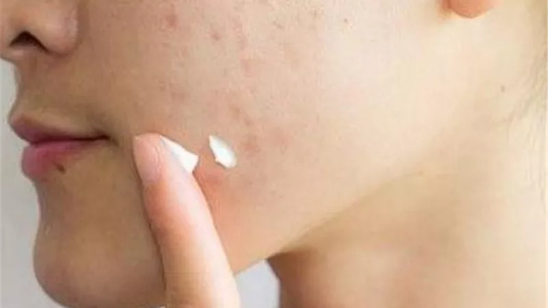 بسبب بثور الوجه.. فتاة تصاب بعدوى نادرة فى قاع الدماغ