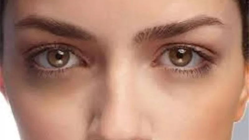 الهالات السوداء.. عادات سيئة تطفئ إشراقتك
