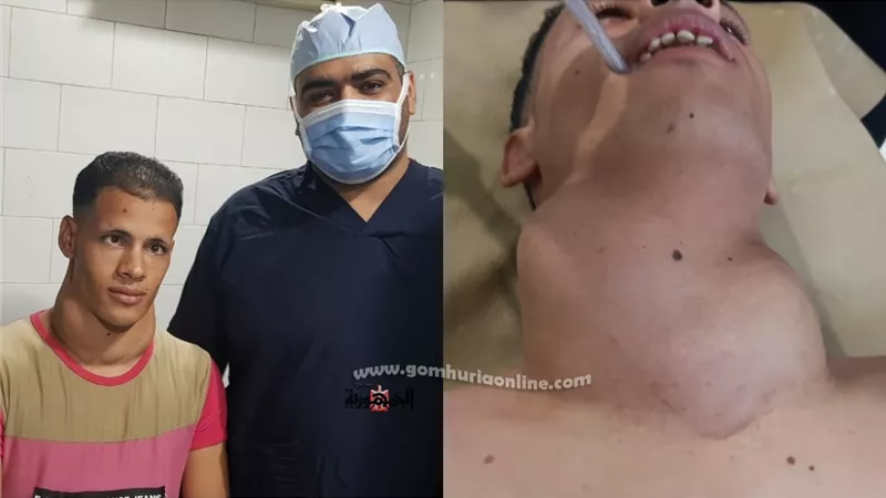 استئصال ورم بالغدة الدرقية لشاب في عقده الثاني بمعهد جنوب مصر للأورام