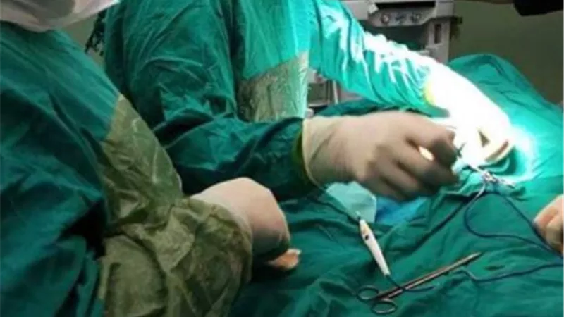 جراحة نادرة لاستخراج عظم ورأس من داخل بطن مولود