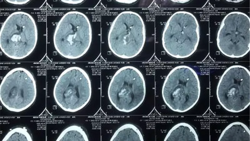 لأول مرة فريق جراحي ينقذ حياة طفلة مصابة بنزيف في بطينات المخ بالدقهلية