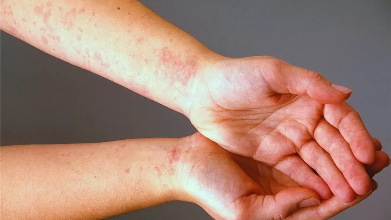 مرض يقلل الإصابة بكورونا.. باحثون يكشفون