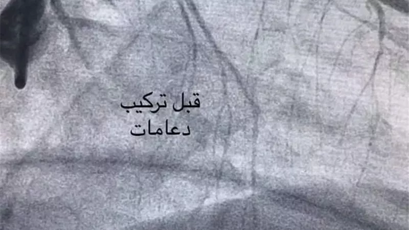 نجاح فريق طبى بمستشفى المنصورة الدولى بتركيب 3 دعامات دوائية لمريض مسن