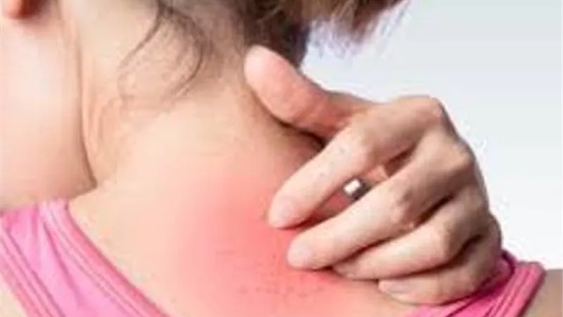 بالفيديو.. اكتشاف نوع من الطفح الجلدي ينذر بالإصابة بفيروس كورونا