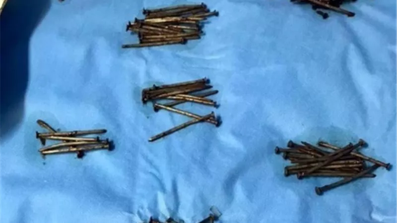 انقاذ حياة مريض بلع 230 مسمارا وقطع زجاجية.. تفاصيل