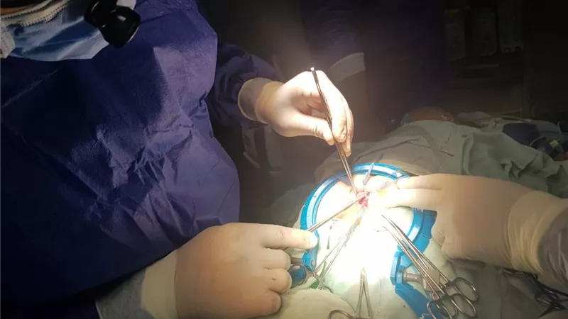 لاول مره ببنى سويف : أصلاح عيب خلفى بالقولون لطفل