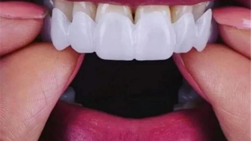 أخصائي تجميل الأسنان يوضح مفهوم «هوليود سمايل»