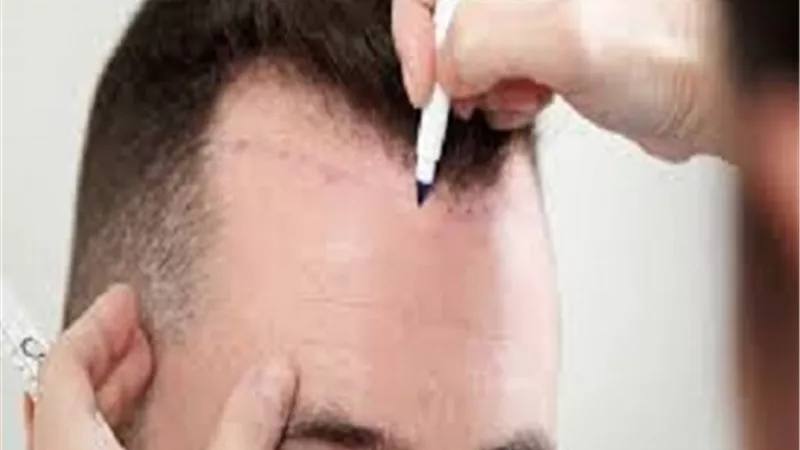 لمرضى الصلع.. إليك كل ما تريد معرفته عن العلاج بالبلازما