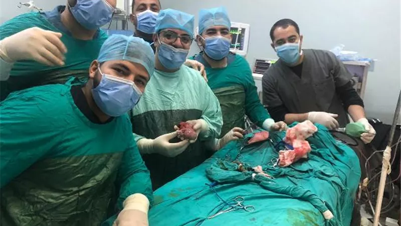 جراحة نادرة بمستشفيات جامعة المنيا لاستئصال توأم مسخى من طفلة لأم مصابة بكورونا