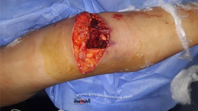 أطباء تخصصي بنى سويف أنقذوا يد المريضة من البتر