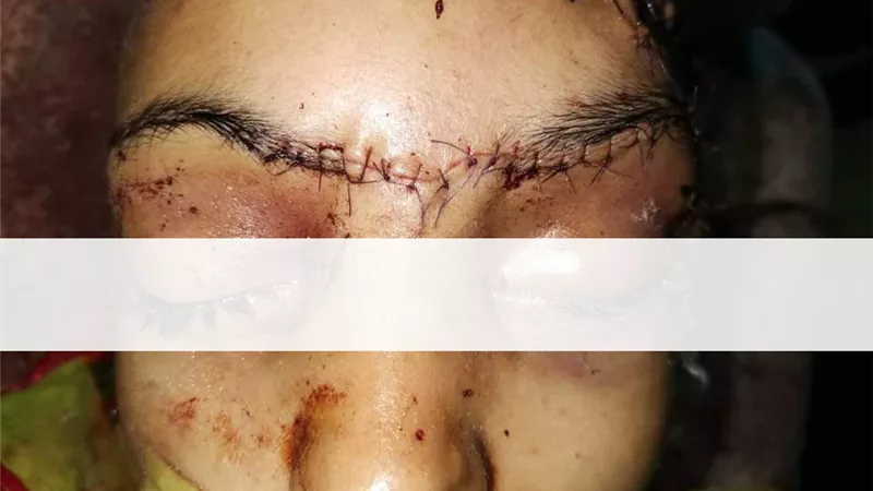 فريق طبي بمستشفي سوهاج الجامعي ينجح في استخراج 