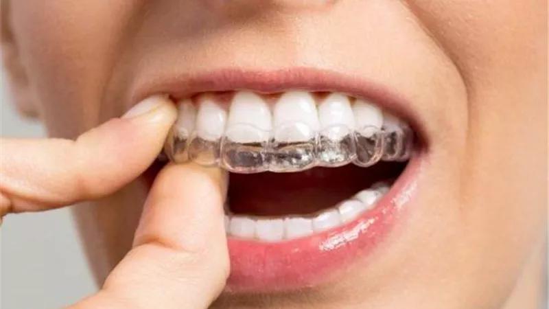 كل ماتريد معرفتة عن تقوم الأسنان