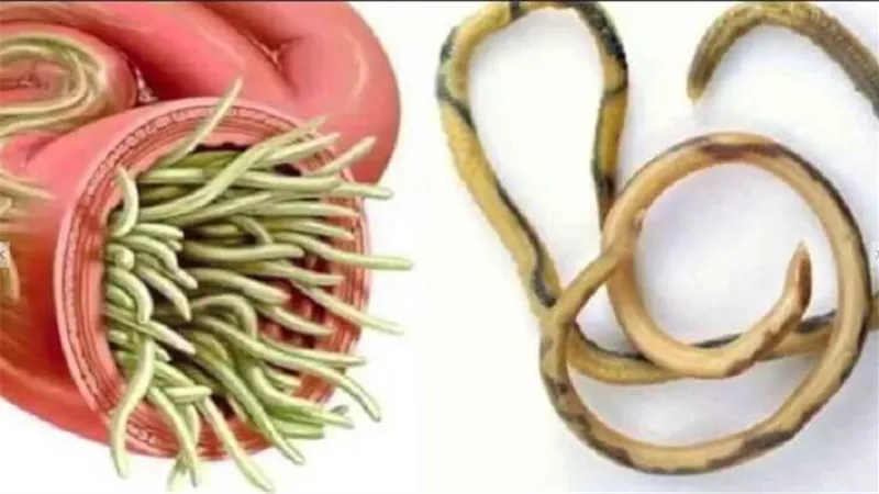 استخراج دودة من أمعاء رجل طولها 18 مترا