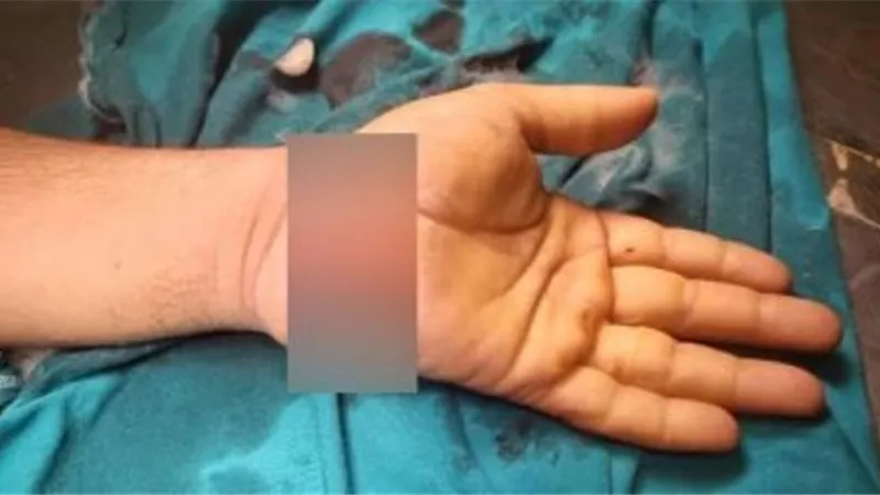 نجاح عملية توصيل كف شاب مبتور بجامعة المنصورة