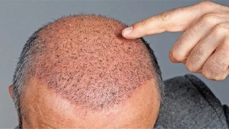 الفيديو... استشاري تجميل: زراعة الشعر تتم من خلال التخدير الموضعي بحد أقصى 8 ساعات