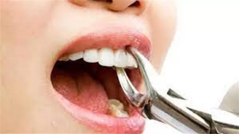 هل خلع الضرس يفطر ..؟الافتاء تجيب