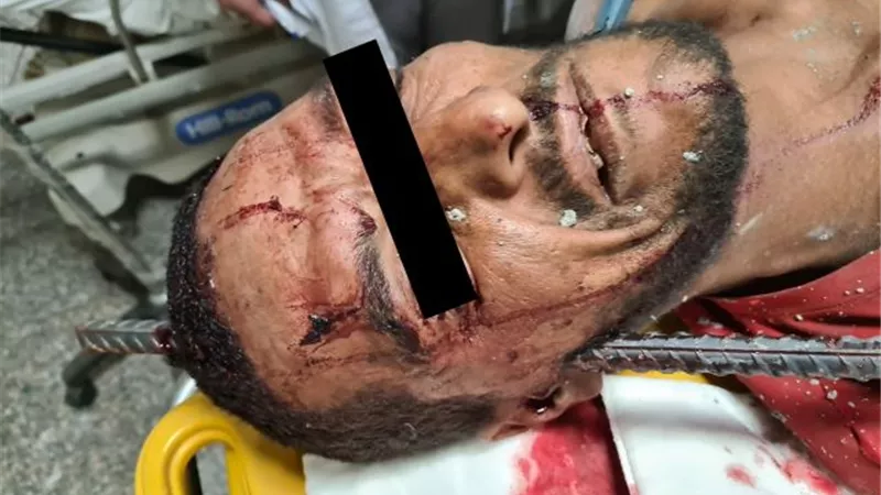 طب جامعة أسيوط تنجح فى إستخراج سيخ حديد من جمجمة شاب.. بالصور